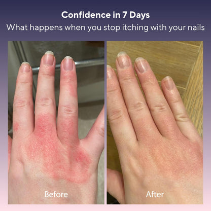 Itch Relieving Scratch Stone